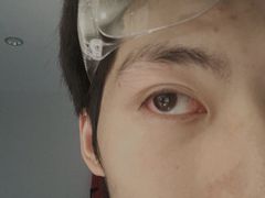 -黑马眼科·近视手术