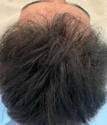 -大麦微针植发全国连锁