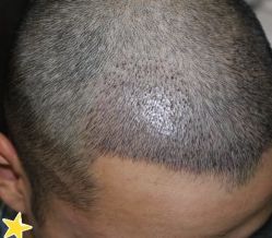 -大麦微针植发丨全国连锁