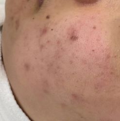 -蕾特恩专业祛痘·皮肤管理