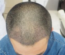 -大麦微针植发丨全国连锁