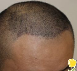 -大麦微针植发丨全国连锁