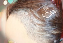 -大麦微针植发全国连锁