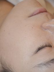 体验前-清疣美疣·痣·斑净肤中心