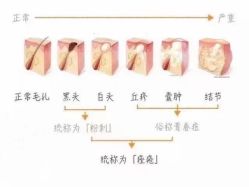 -苗方清颜专业祛痘连锁机构