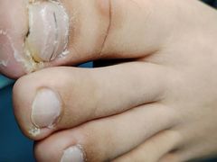 -祖传修脚甲沟炎灰指甲鸡眼
