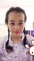 点击看大图 -大麦微针植发丨全国连锁