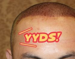 -大麦微针植发丨全国连锁