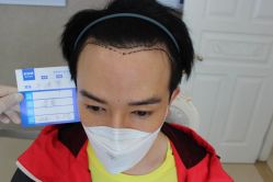 -大麦微针植发丨全国连锁