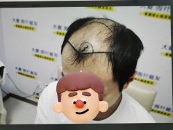 -大麦微针植发丨全国连锁