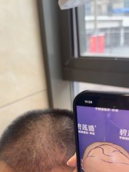 -碧莲盛·不剃发植发