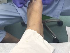 治疗后-Andrew指甲专科灰指甲·甲沟炎矫正·3D步态矫形鞋垫定制(上海法华镇路旗舰店)