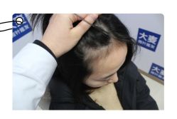-大麦微针植发全国连锁