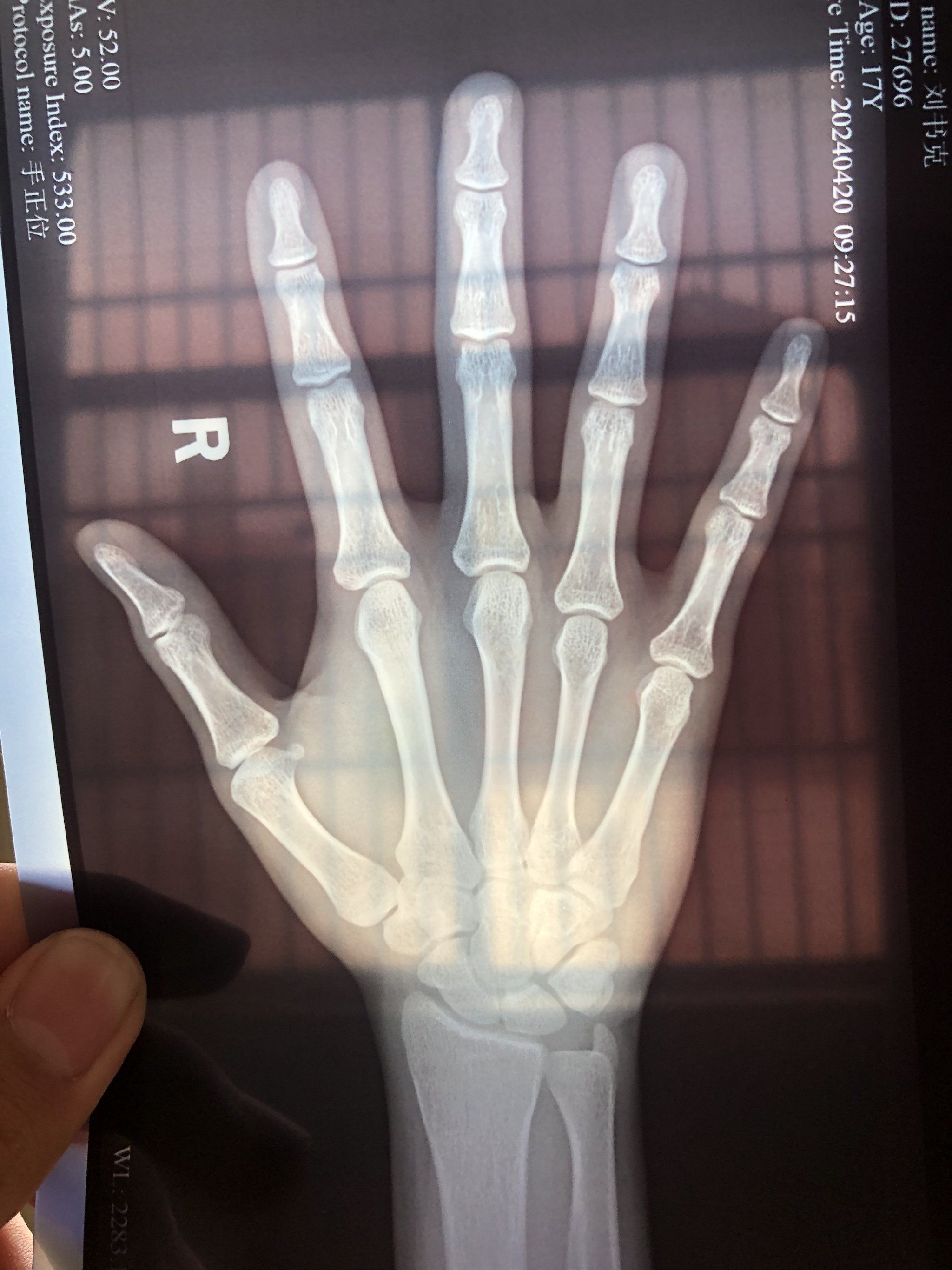 成长轨迹:骨骼x光对比