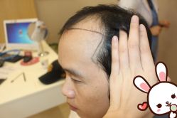 -大麦微针植发丨全国连锁