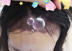 -大麦微针植发全国连锁