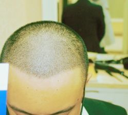 -大麦微针植发丨全国连锁
