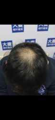 -大麦微针植发丨全国连锁