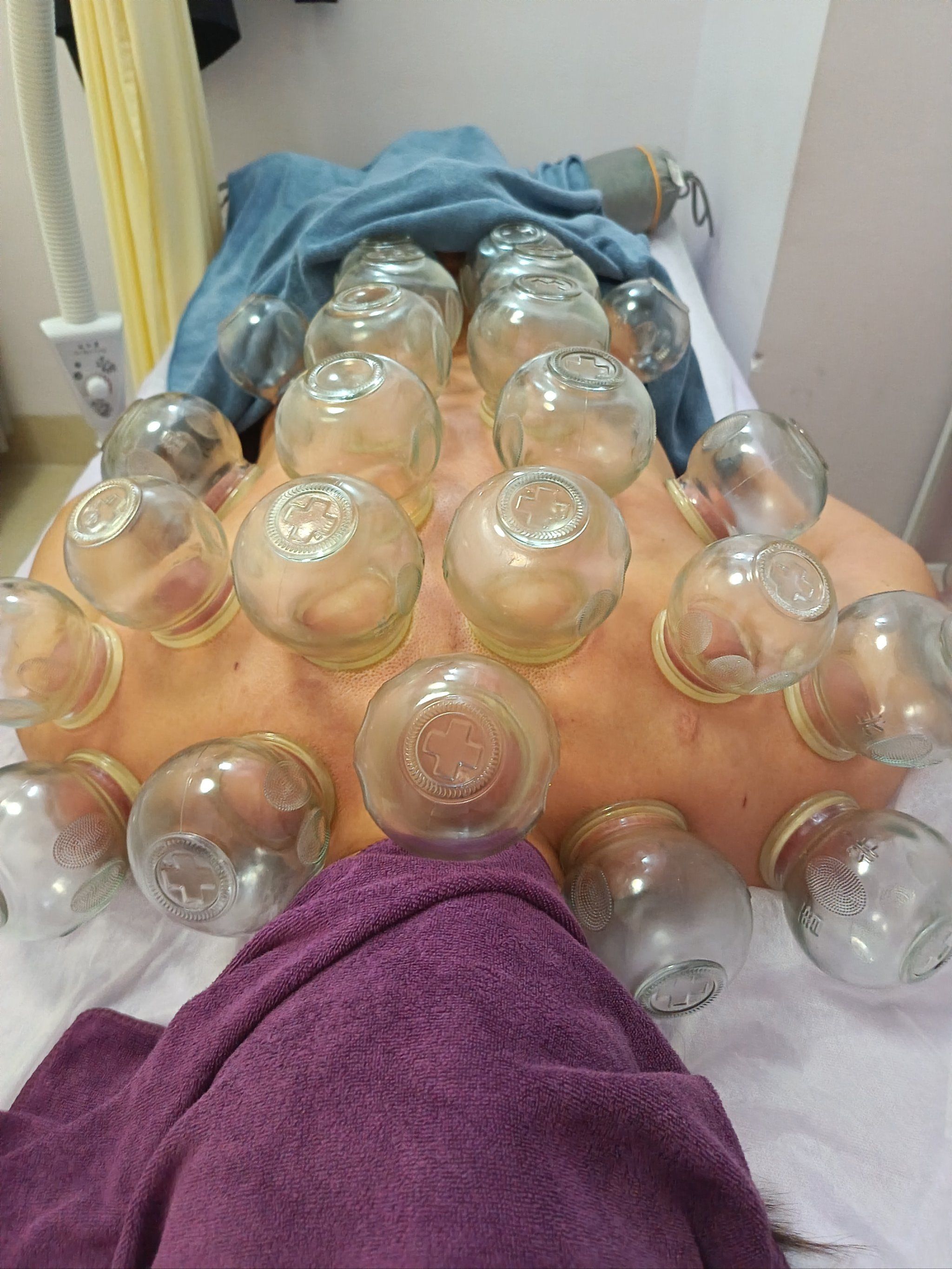 拔罐疗法,中医也能时尚!