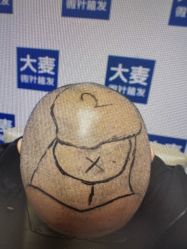 体验前-大麦微针植发丨全国连锁