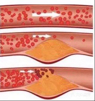 护血管、促循环，受益一辈子