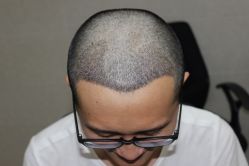 -大麦微针植发丨全国连锁