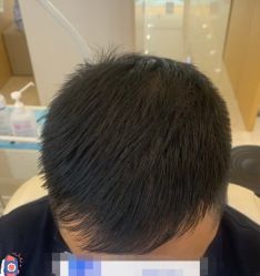 -大麦微针植发丨全国连锁