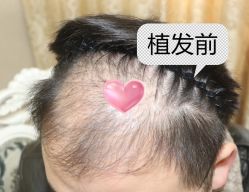 -大麦微针植发全国连锁