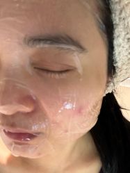 点击看大图 体验后-柠檬一美·Ondapro·轻薄紧致抗衰中心