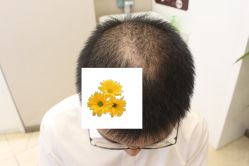 -大麦微针植发丨全国连锁
