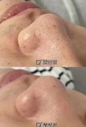 -塑青春&伊肤泉祛痘皮肤管理