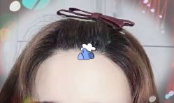 -大麦微针植发全国连锁