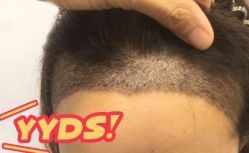 -大麦微针植发丨全国连锁