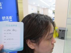 -碧莲盛·不剃发植发