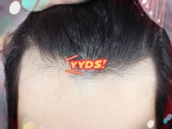 -大麦微针植发全国连锁