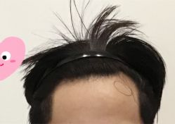 -大麦微针植发全国连锁