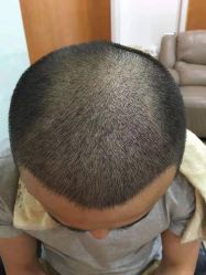 体验后-大麦微针植发全国连锁