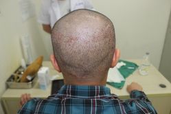 点击看大图 -大麦微针植发丨全国连锁