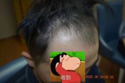 体验前-大麦微针植发全国连锁