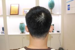 点击看大图 -大麦微针植发丨全国连锁