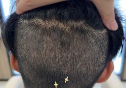 -大麦微针植发全国连锁