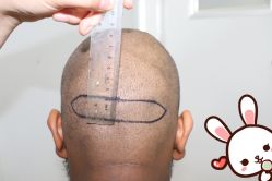 点击看大图 -大麦微针植发丨全国连锁