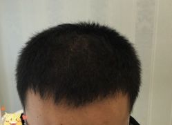 -大麦微针植发丨全国连锁
