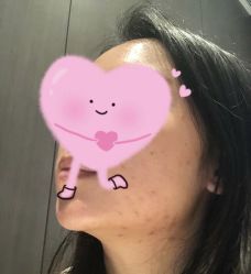 体验前-广东韩妃整形外科医院