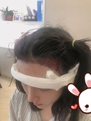 点击看大图 -大麦微针植发丨全国连锁