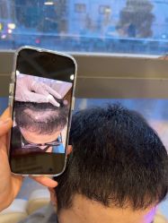 -碧莲盛·不剃发植发