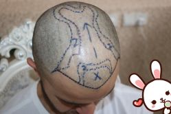 -大麦微针植发丨全国连锁