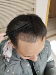 点击看大图 -大麦微针植发丨全国连锁