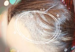 -大麦微针植发全国连锁