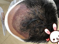 -大麦微针植发丨全国连锁